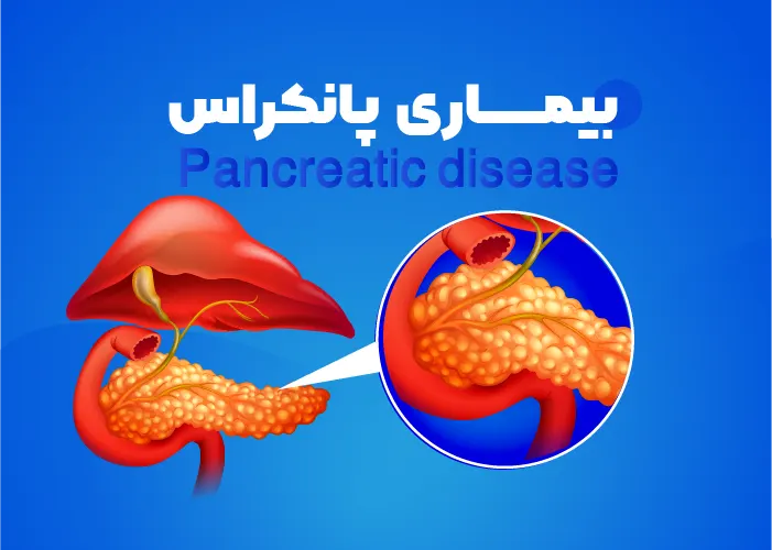 بیماری پانکراس + انواع، علائم، علل، عوارض و درمان