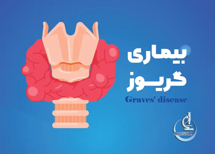 بیماری گریوز چیست؟ علل، علائم و درمان